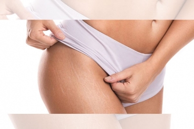 Difference between Red and White Stretch Marks Explained and It’s Natural to Have Them Difference between Red and White Stretch Marks Explained and It’s Natural to Have Them