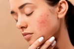 skin care, skin care products, 10 ways to get rid of pimples at home, Pimples skin care, skin care products, 10 ways to get rid of pimples at home, Pimples